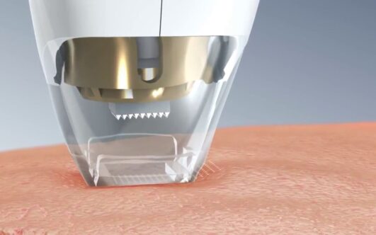 Mezotix: Rejuvenece tu piel con lo último en tecnología estética